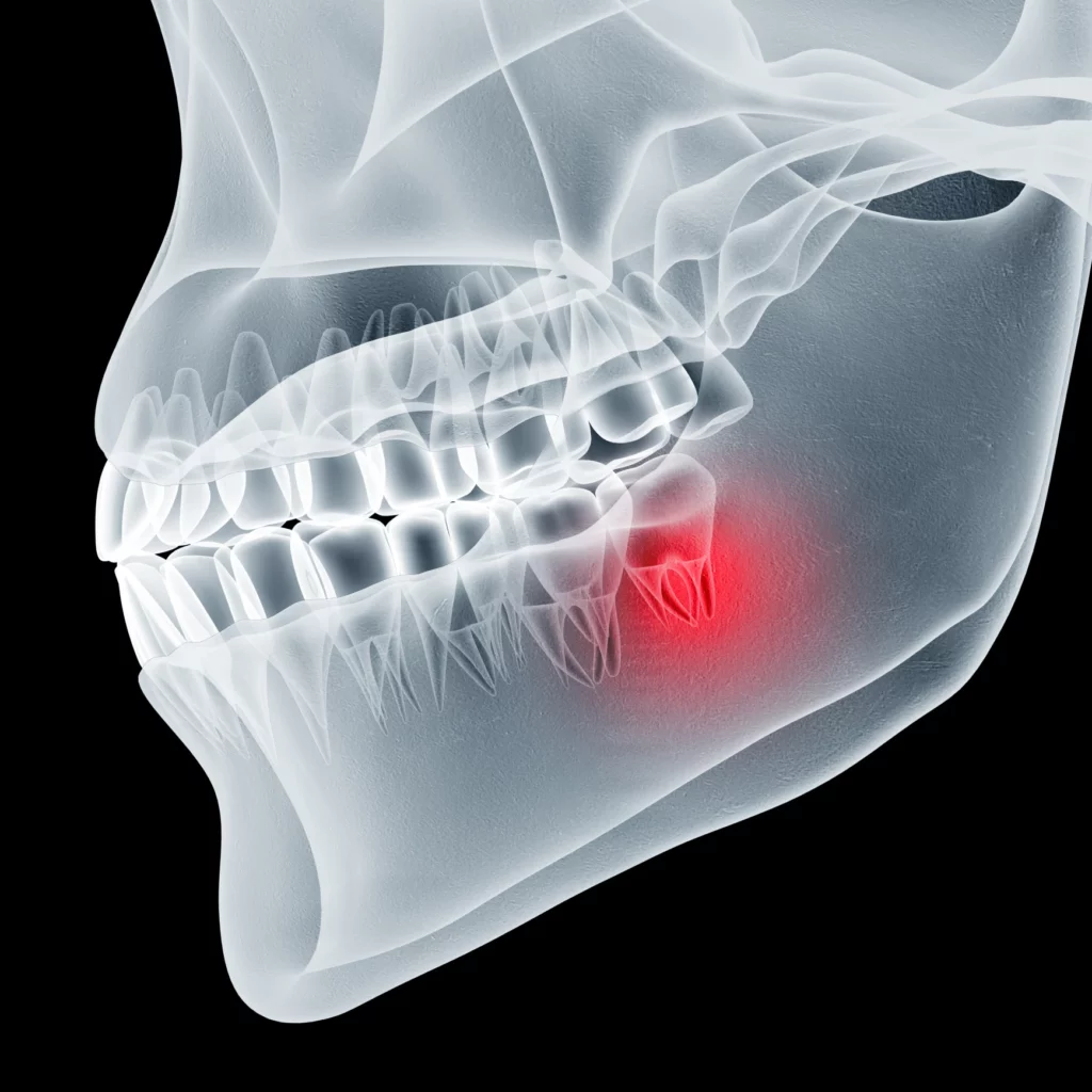 wisdom teeth removal in Edmond, OK