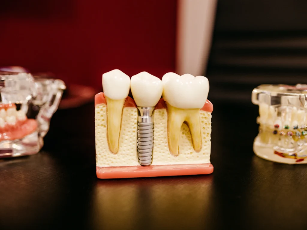 model of a single tooth dental implant | cost of dental implants in Edmond, OK