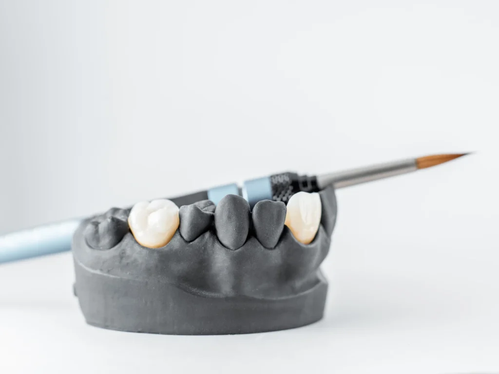 lower jaw model with porcelain dental crowns | same-day crowns in Edmond, OK